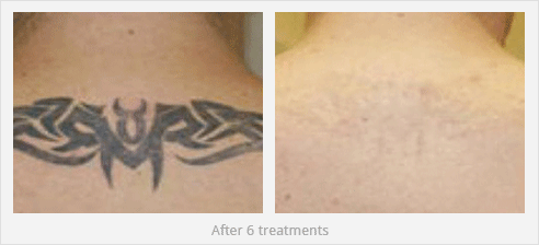 Vertical Picosecond Laser Tattoo Removal Machine Pigmentation Removal Acne Treatment