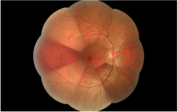 Professional Non Mydriatic Fundus Camera For Accurate Imaging