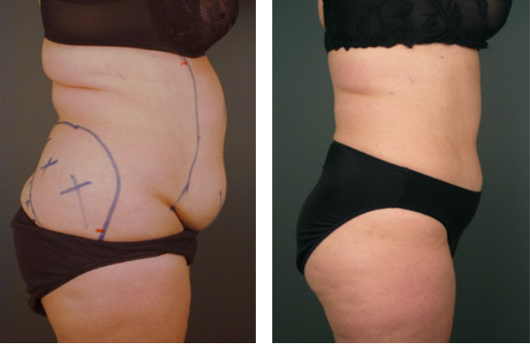 300W Surgical Abdomen Liposuction Slimming Machine