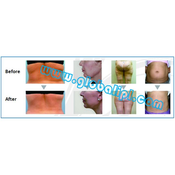 Portable Ultrasonic Cavitation Slimming Machine
