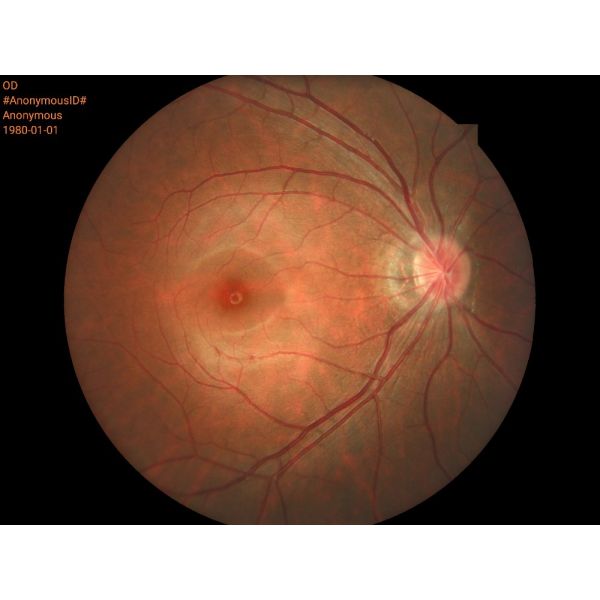 Portable Digital Fundus Camera with Ce Approval (HA06)