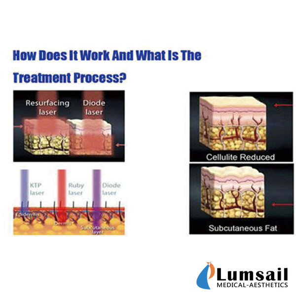 Lipo Multifunctional Diode Laser Machine Fat Reduction