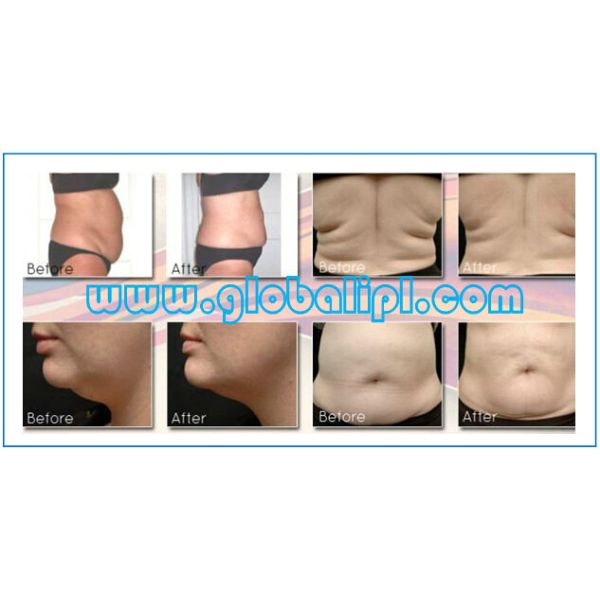 Fat Freezing Slimming Machine Cryolipolysis Machine For Body Shaping