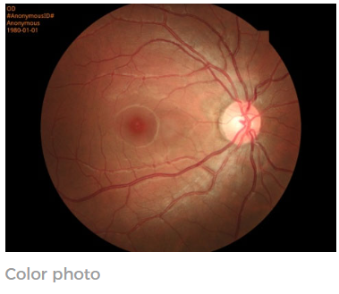 Non Mydriatic Automatic Fundus Camera Retinal Fundus Camera Imaging Red Free